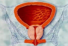 前列腺增生怎样治疗？