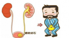 膀胱炎的早期症状是什么